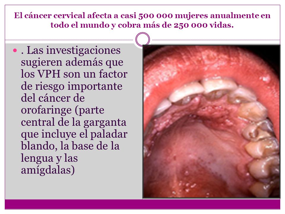 como se detecta el germ del papiloma humano linear unit solfa syllable garganta